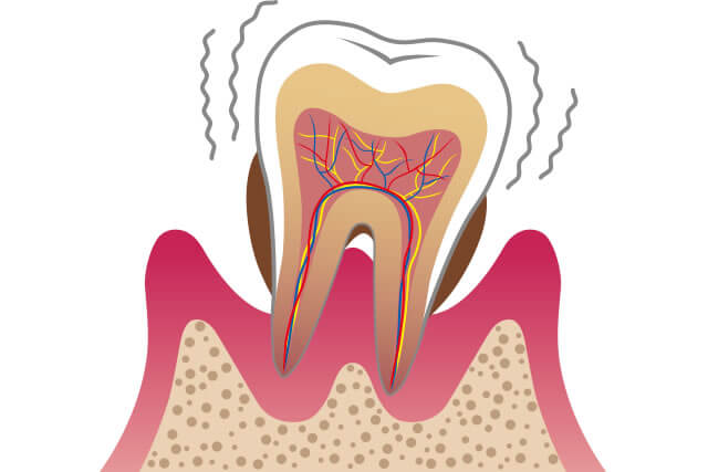 歯周病治療